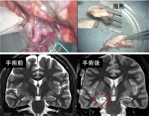 シルビウス裂アプローチによる選択的海馬切除。