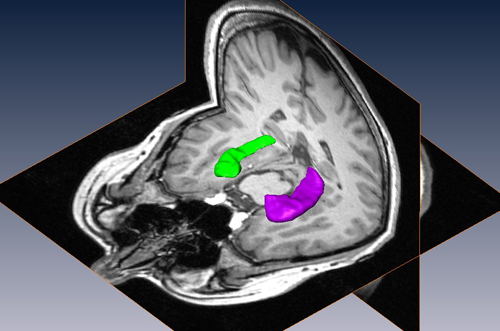 画像処理による海馬の体積測定(volumetry)を診断に役立てています。