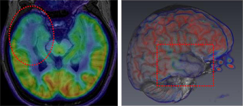 この患者さんのMRIは正常でしたが、FDG-PET検査によって右側頭葉の異常が見つかりました（赤破線内）。