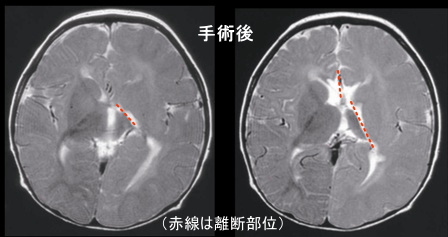 画像：手術後